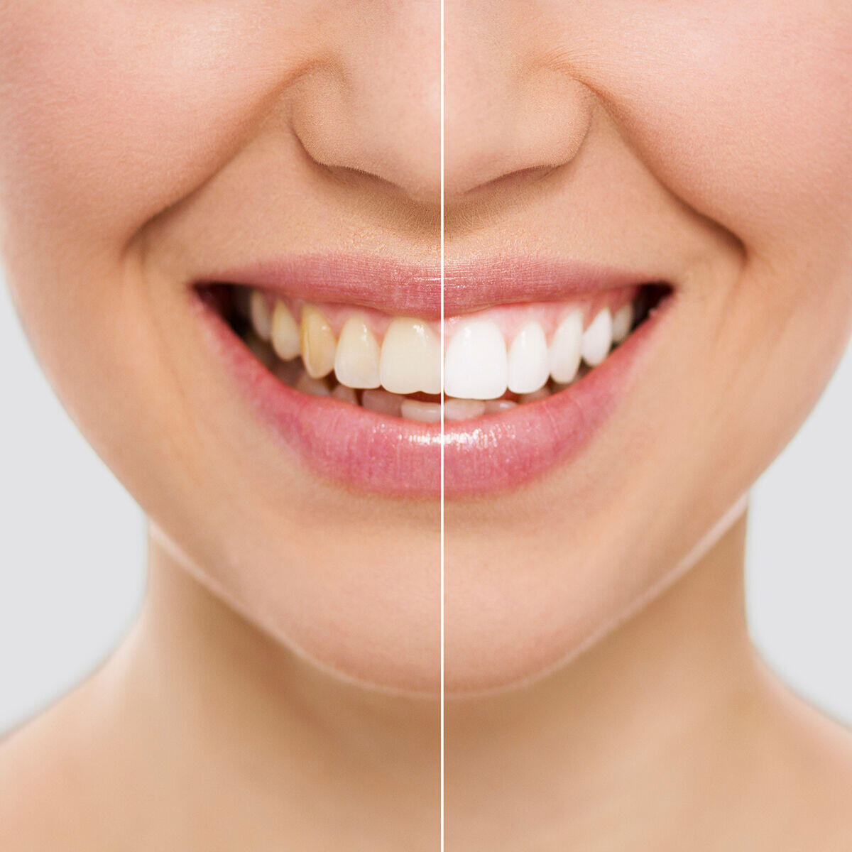 lapiz blanqueador dental